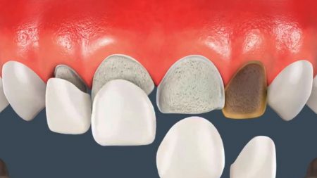 Phương pháp phục hình răng giả được sử dụng phổ biến