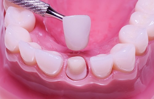 Chất lượng của răng sứ kim loại thường-1