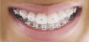 Niềng răng khểnh ở đâu 