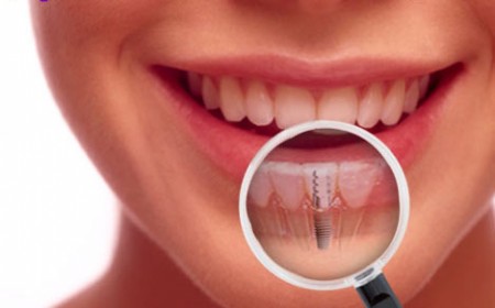 cấy răng implant phương pháp tối ưu
