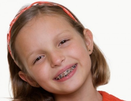 Chọn loại mắc cài nào phù hớp với trẻ để niềng răng?