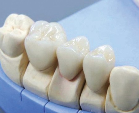 Tại sao cercon là răng sứ thẩm mỹ cao cấp