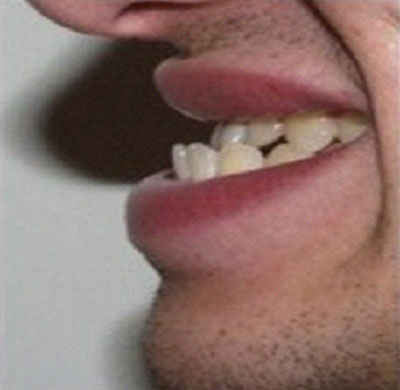 Phương pháp điều trị răng móm
