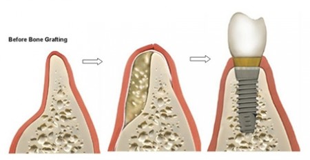 Làm gì để cấy ghép implant khi xương hàm nhỏ ?