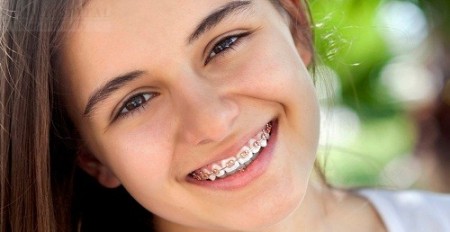Niềng răng bằng mắc cài sứ giá bao nhiêu