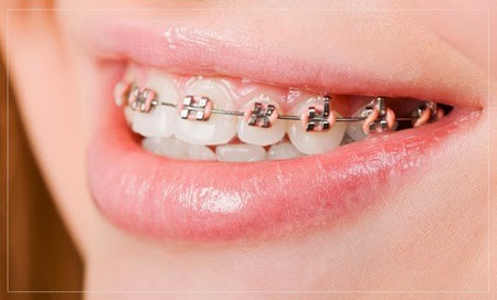 Niềng răng một hàm có hiệu quả không? 