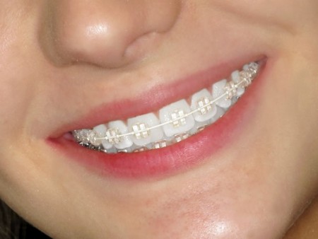 Niềng răng thẩm mỹ có hiệu quả không?