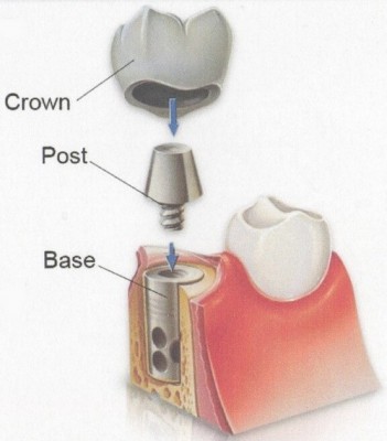 Những phương pháp làm răng giả chất liệu sứ