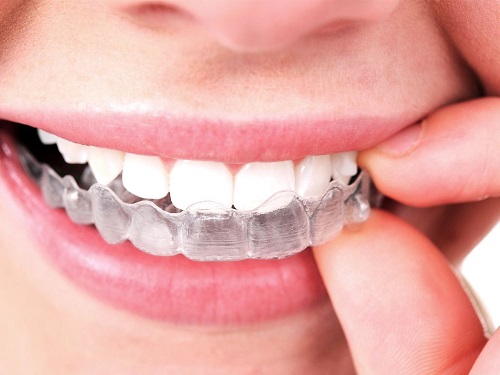 Giải pháp niềng răng bằng nhựa bạn đã biết chưa?-1