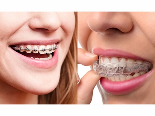 Giải pháp niềng răng bằng nhựa bạn đã biết chưa?-2