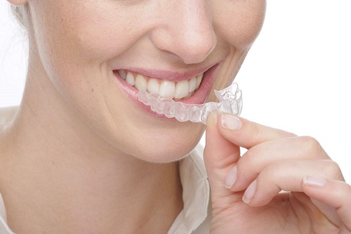 Giải pháp niềng răng bằng nhựa bạn đã biết chưa?-3