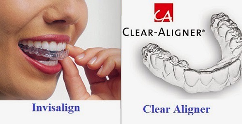 Giải pháp niềng răng bằng nhựa bạn đã biết chưa?-4