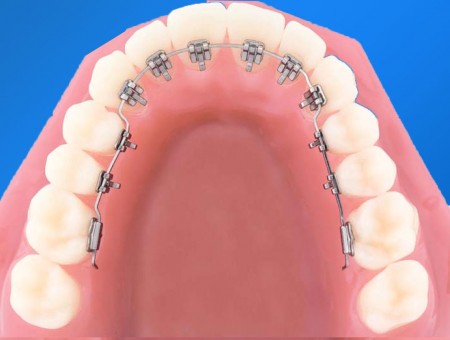 Chi phí niềng răng mặt trong