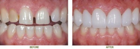Răng sứ Cercon có tuổi thọ lâu không? 1