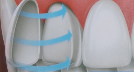 Ưu điểm của mặt dán sứ