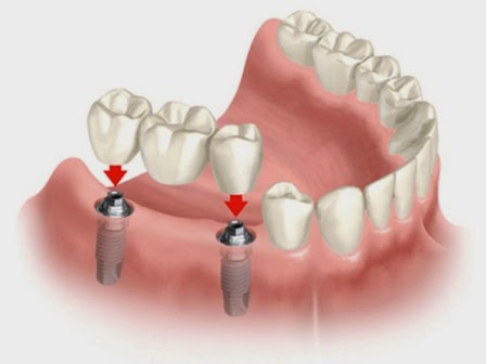 Chọn nha khoa uy tín để cấy ghép implant răng hàm-1