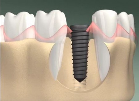 Khi nào nên trồng răng implant?-1