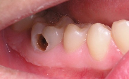 Triệu chứng  bệnh sâu răng