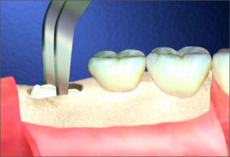 Quy trình chữa răng sâu