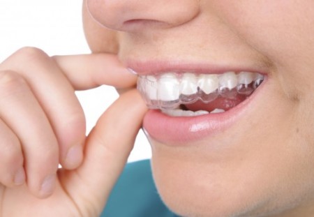 Tác dụng của hàm duy trì sau khi tháo niềng răng