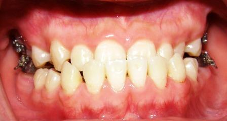 Điều trị niềng răng móm có phải nhổ răng không? 1 Điều trị niềng răng móm có phải nhổ răng không? 1