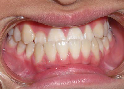 Điều trị niềng răng móm có phải nhổ răng không? 2 Điều trị niềng răng móm có phải nhổ răng không? 2