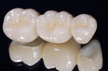 Sử dụng răng giả bằng sứ phục hình răng bị mất 