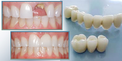 Sử dụng răng giả bằng sứ phục hình răng bị mất 