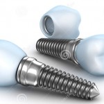Tại sao cấy ghép trụ implant có chi phí cao?