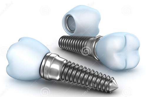 Ưu điểm của trụ răng implant Osstem 1