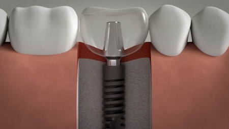 Tại sao cấy ghép trụ implant có chi phí cao?