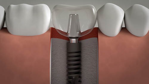 Quy trình cấy ghép răng implant hiệu quả