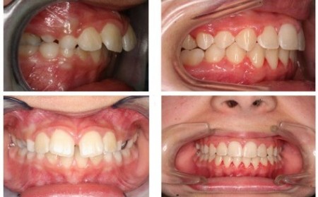 Niềng răng hô hàm trên mất bao lâu 