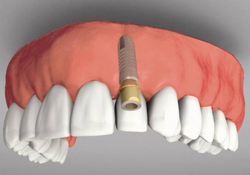 Độ an toàn của cấy ghép răng implant 