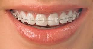 Những lợi ích khi niềng răng 1
