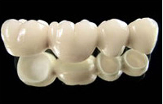 Phục hình răng giả với răng sứ