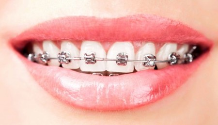 Các loại niềng răng nha khoa 2