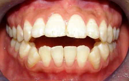 Nên làm gì khi răng bị hô hai hàm? 