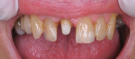 Quy trình đầy đủ thẩm mỹ răng nhiễm tetracycline 1