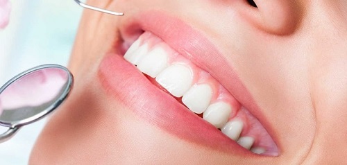Cách cứu chữa chiếc răng bị viêm tủy 2