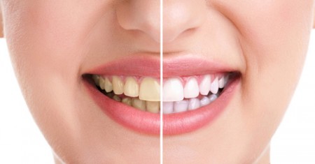 Tẩy trắng răng duy trì được bao lâu? 1