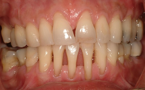 Bệnh tụt lợi gây ảnh hưởng đến sức khỏe răng miệng 1