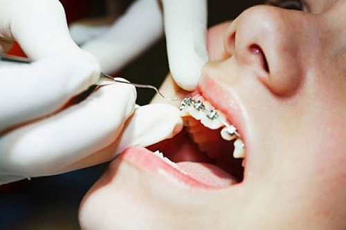 Điều trị niềng răng giúp phục hình thẩm mỹ nụ cười-2
