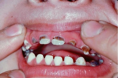 Quy trình chữa bệnh răng sâu-1