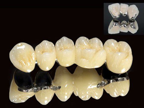 Các loại mão răng sứ-2 Các loại mão răng sứ-2