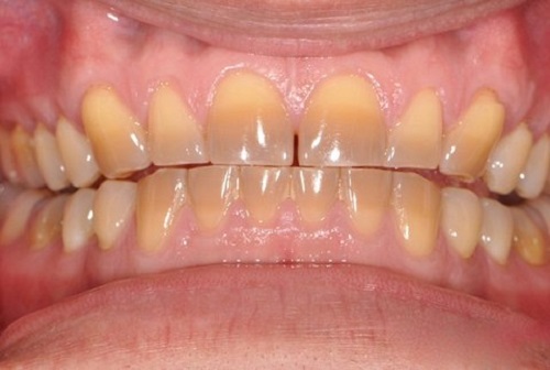 Tẩy trắng răng nhiễm tetracycline có độc hại không? 1