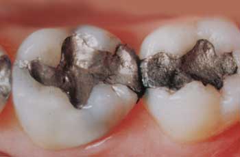 Yếu tố ảnh hưởng tới chi phí trám răng 1