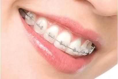 Cách chăm sóc hàm răng sau khi tháo mắc cài-1