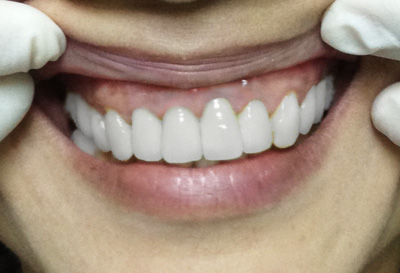 Chăm sóc hàm răng sau khi bọc răng sứ thẩm mỹ