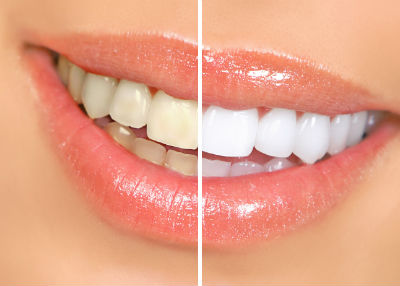 Răng bị sẫm màu có nên tẩy trắng răng không 1